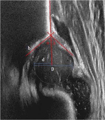 Morphological Development of the Hip in Normal Infants Under Six Months of Age by the Graf Ultrasound Method